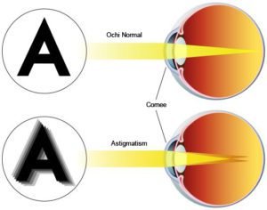 ASTIGMATISM