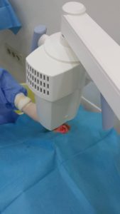 SIMPTOME KERATOCONUS