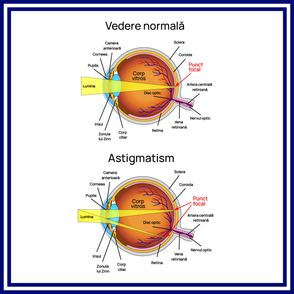 astigmatism