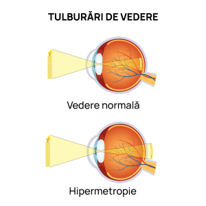 Simptome Hipermetropie